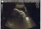 Emily Ultrasound (2)