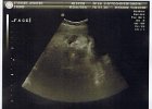 Emily Ultrasound (3)