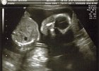 Emily Ultrasound (4)