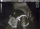 Emily Ultrasound (5)