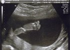 Emily Ultrasound (6)