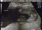 Emily Ultrasound (7)