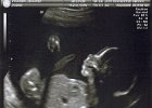 Emily Ultrasound (8)