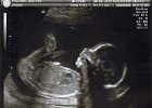 Emily Ultrasound (9)