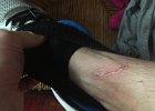 Chris Leg Wound (2)